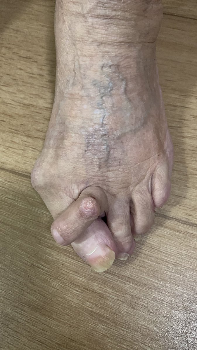 This is a tricky situation. The second toe here is the most painful toe. My 90 year old patient has two options. An extensive bunion and 2nd toe correction or a simpler amputation of the second toe. In certain very selective cases this is an excellent option. #foot #surgery