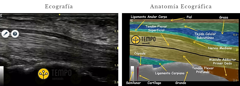 ISOECOICO
"Es una estructura con un nivel de Gris similar a las estructuras periféricas."