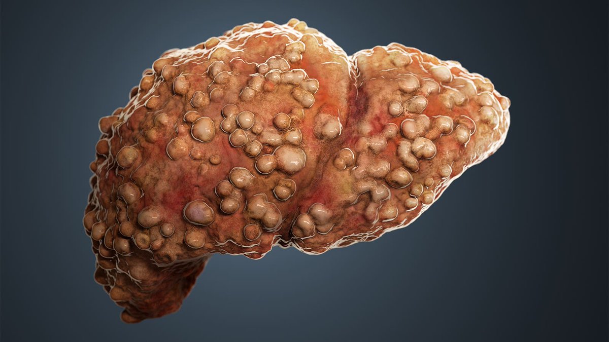 Esteatosis hepatica dieta Esteatosis hepatica dieta