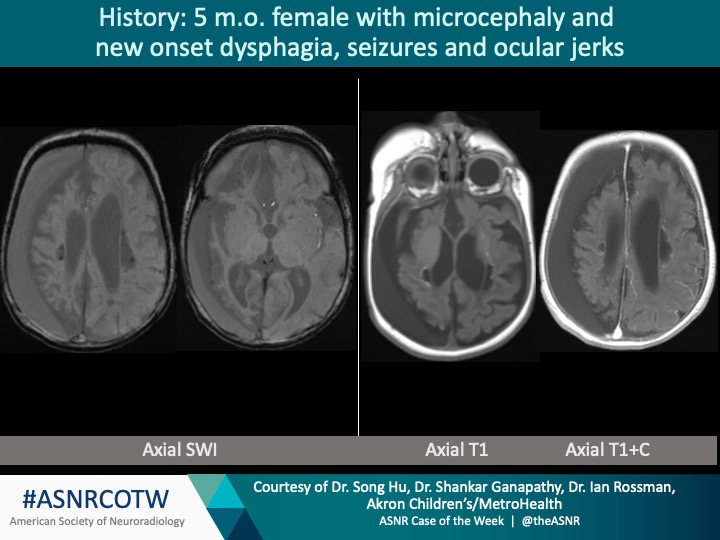The American Society of Neuroradiology (@theasnr) on Twitter photo ASNR COTW #98
Hx: microcephaly and new onset dysphagia, seizures, and ocular jerks
NO SPOILERS! Give hints in the form of GIFs or answer the attached poll.
Answer in 24 hours.
#neuro #Neurorad #Erad #radres #FOAMrad #FOAMrad #medtwitter #ASNRCOTW <a href="/SriniGanapathy/">Shankar Srinivas (Srini) Ganapathy</a> ASNR COTW #98
Hx: microcephaly and new onset dysphagia, seizures, and ocular jerks
NO SPOILERS! Give hints in the form of GIFs or answer the attached poll.
Answer in 24 hours.
#neuro #Neurorad #Erad #radres #FOAMrad #FOAMrad #medtwitter #ASNRCOTW <a href="/SriniGanapathy/">Shankar Srinivas (Srini) Ganapathy</a>