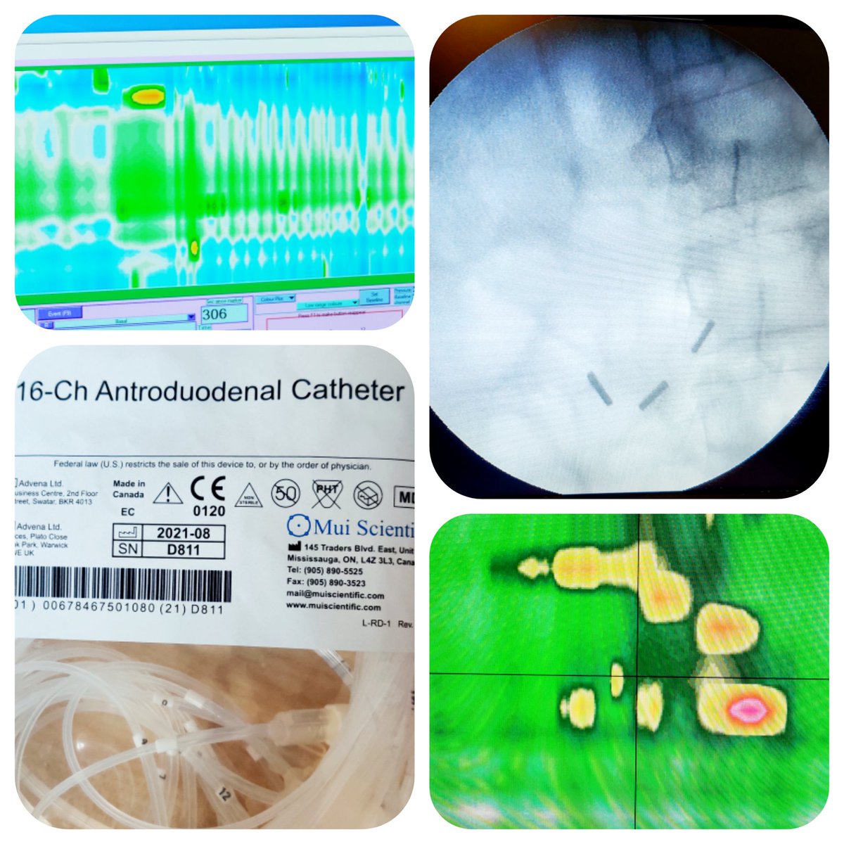 Proud to kick start Antroduodenal Manometry in our Neurogastroenterology & GI Motility Lab at @medanta...we are now one of the very few centers in India if not the world to do Antro-Duodenal Manometries...#firsttime #Neurogastro #GITwitter #Gastroparesis #MedTwitter