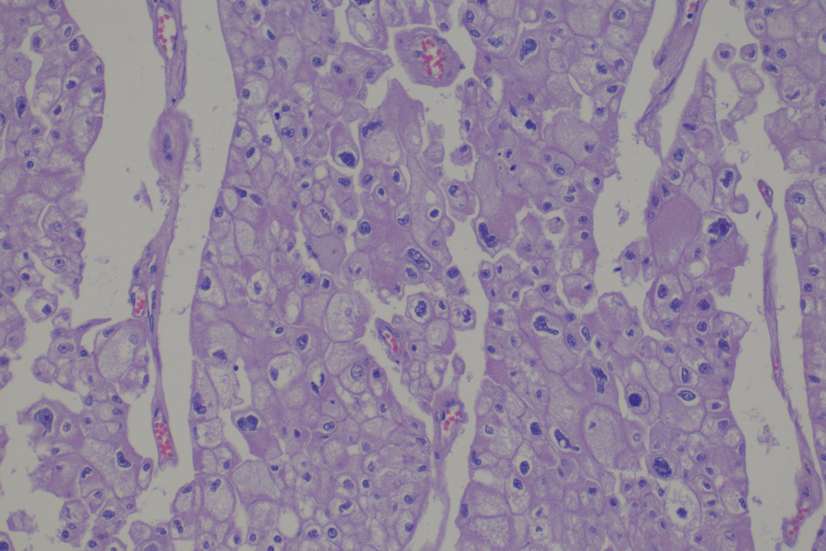 Would you call this chromophobe carcinoma sarcomatoid? #renalcellcancer #Gupath