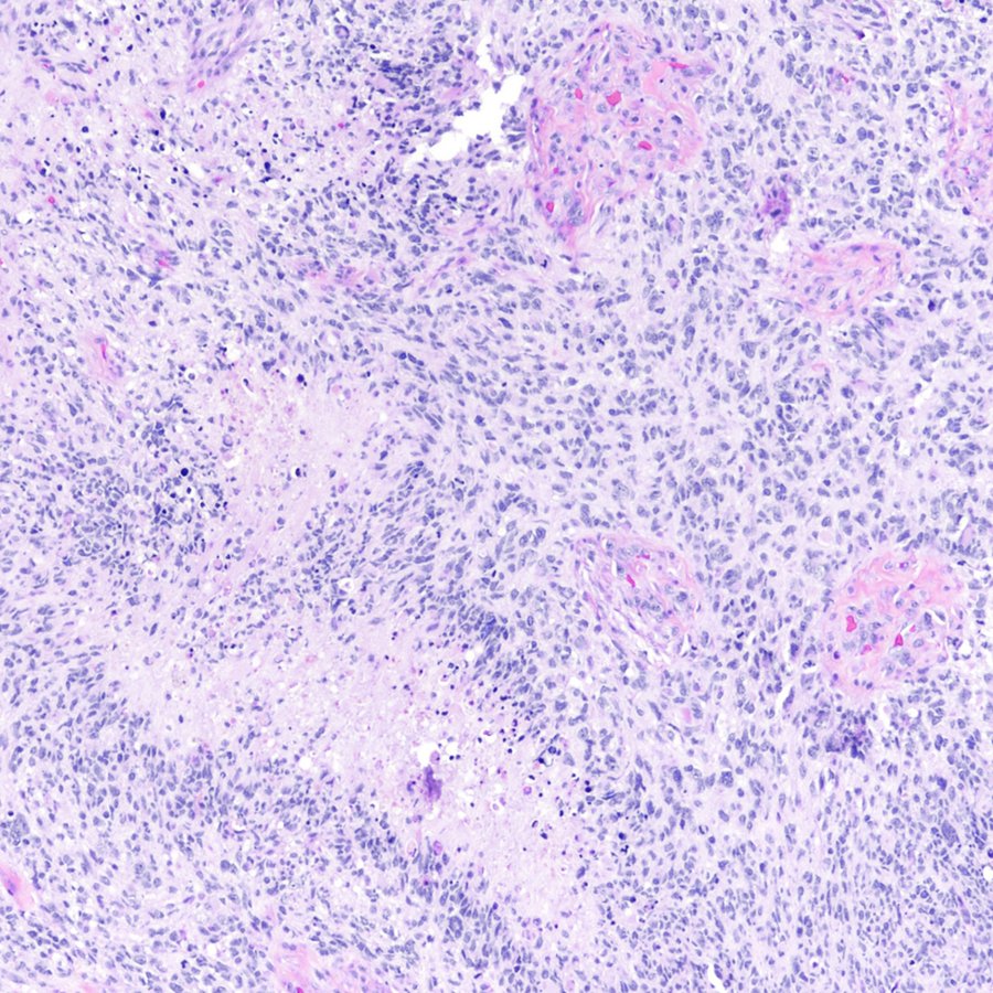 Brain mass. One picture is all you need. Diagnosis? #pathology #neuropath #PathTwitter