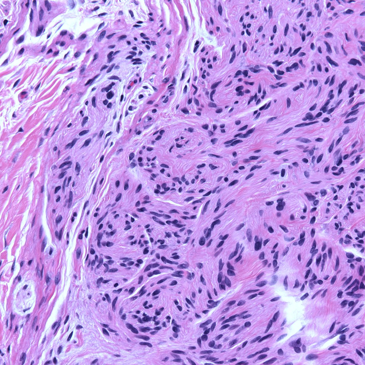 Adult, face lesion—some clues to site here. #dermpath #pathology #dermatology #dermtwitter