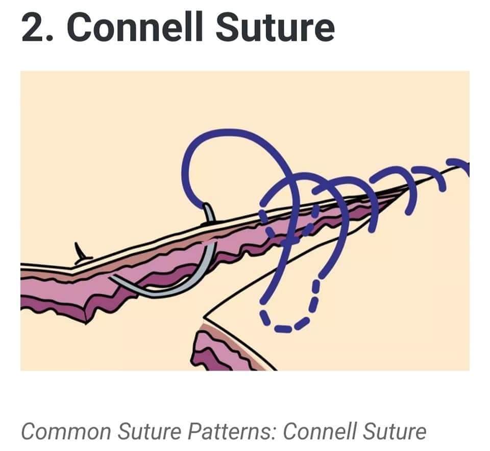 Appendiceal inversion procedure. After the base of the appendix (A) is... |  Download Scientific Diagram