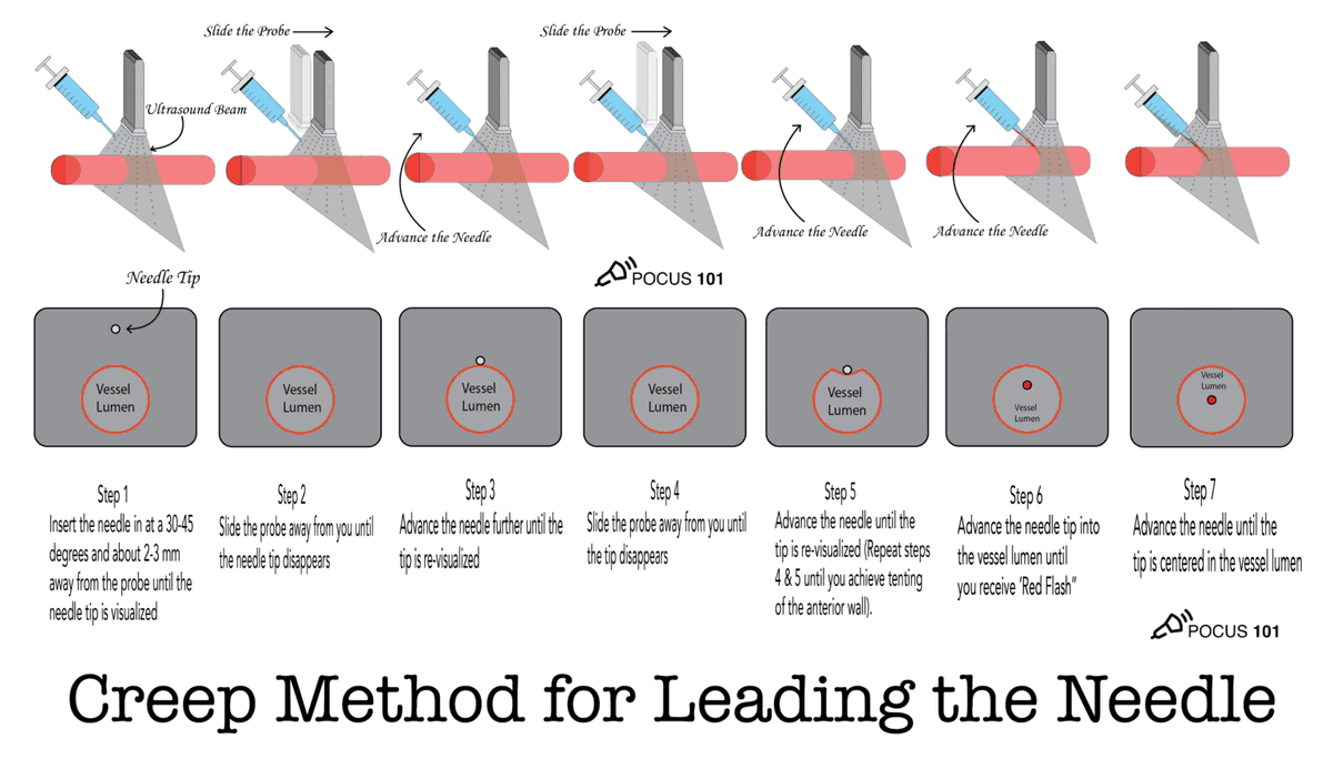 Pocus101's tweet image. New POCUS 101 Blog post on Ultrasound Guided Peripheral IVs (PIV)! #POCUS

Check it out here👉🔗pocus101.com/PIV
