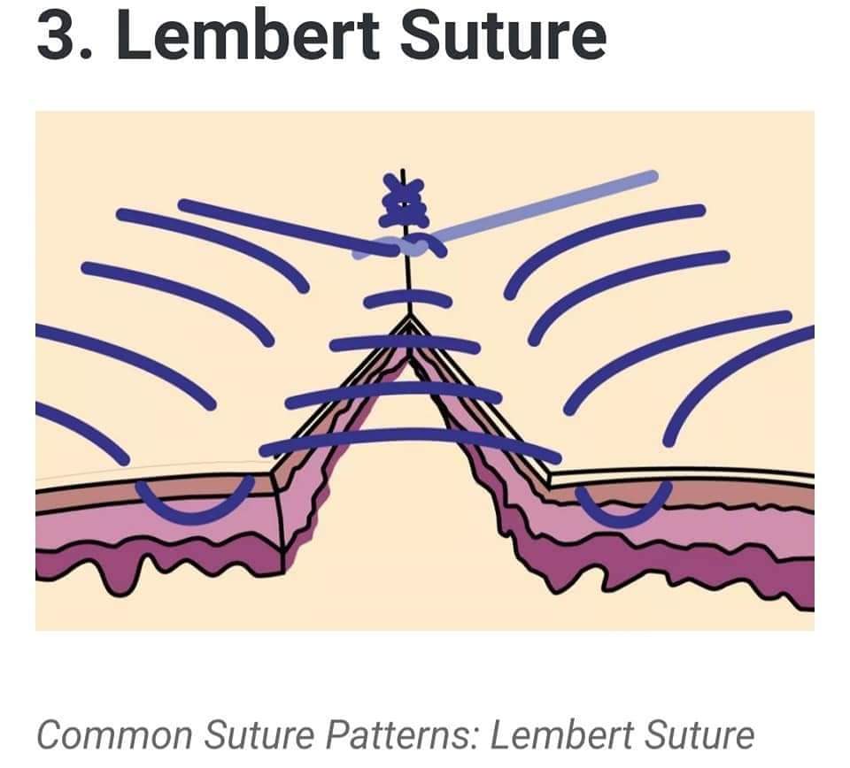 Common Suture Patterns