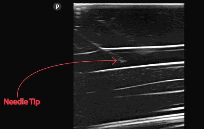 Pocus101's tweet image. New POCUS 101 Blog post on Ultrasound Guided Peripheral IVs (PIV)! #POCUS

Check it out here👉🔗pocus101.com/PIV
