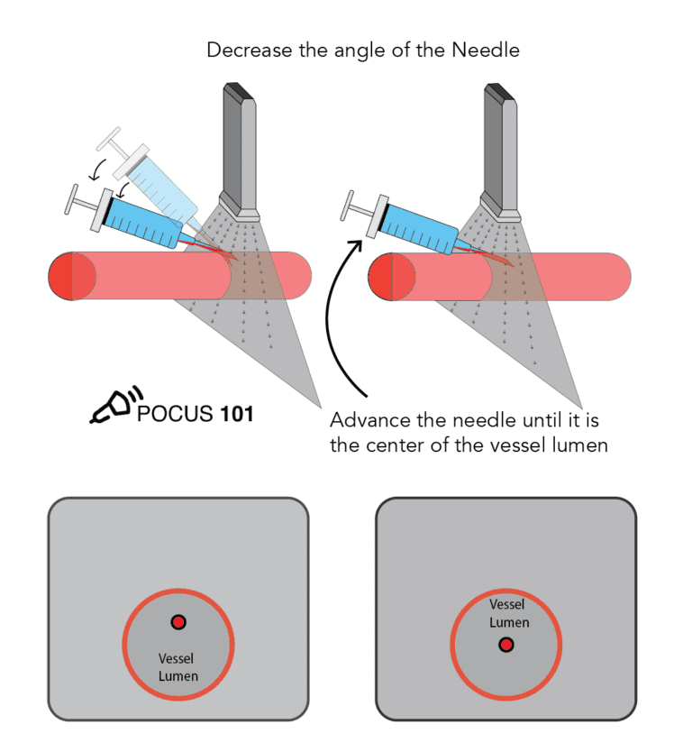 Pocus101's tweet image. New POCUS 101 Blog post on Ultrasound Guided Peripheral IVs (PIV)! #POCUS

Check it out here👉🔗pocus101.com/PIV