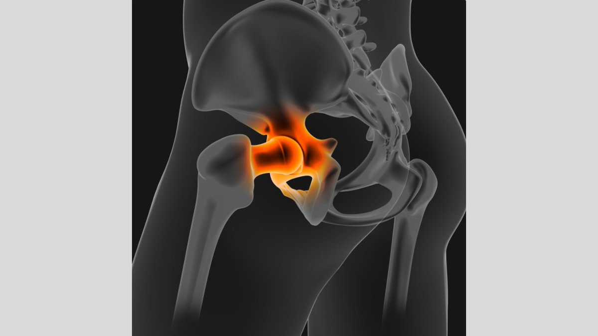 leslievidalmd's tweet photo. The hip is one of the largest joints in your body. It bears your body weight and supports all kinds of movements. When you have #hipproblems, it affects your entire life. If you have hip questions, Dr. Vidal specializes in the following areas: https://t.co/WbPuhwfVZy #hipexpert https://t.co/mfKWLxFf6k