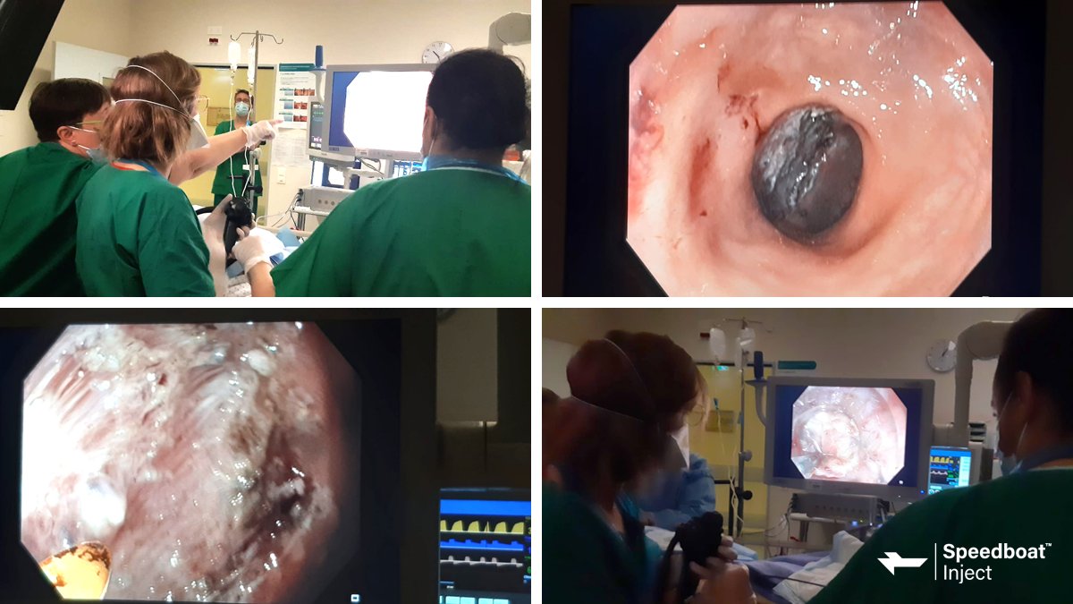 CreoEndoscopy's tweet photo. 🇫🇷 Bravo à Dr Elodie Cesbron &amp; team at the Centre Hospitalier Universitaire d'Angers - fantastic work on her first Speedboat SSD case yesterday! A 60mm LST polyp with mixed granular component was removed en-bloc under the expert mentorship of Dr Roser Vega✨ https://t.co/80KYCgJjvM