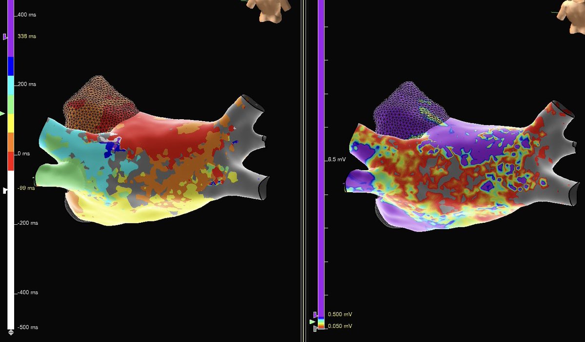 madisonkeithEP's tweet photo. OT vectors + LAT colors help quickly identify clockwise posterior wall aAFL and critical isthmus in this redo patient! #EnsiteX #HDGrid #OnlyWithOT #EPeeps @srissundaram https://t.co/MTtFDbJse8