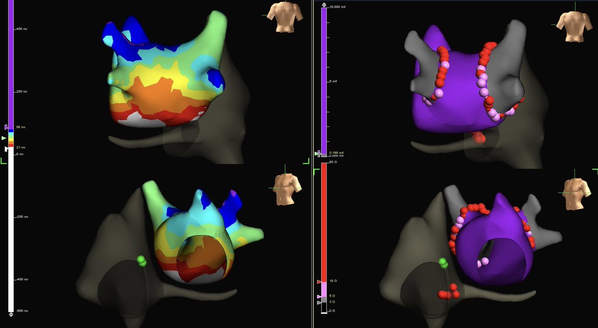 A sequential pair of PVI’s, both with inducible AVNRT & Hx Paroxysmal #AFib @Ashit_EPS @AbbottEP