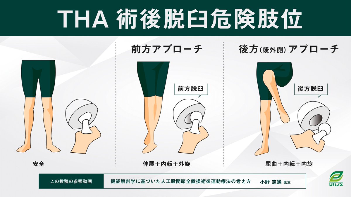 前方 アプローチ 禁忌 肢 位