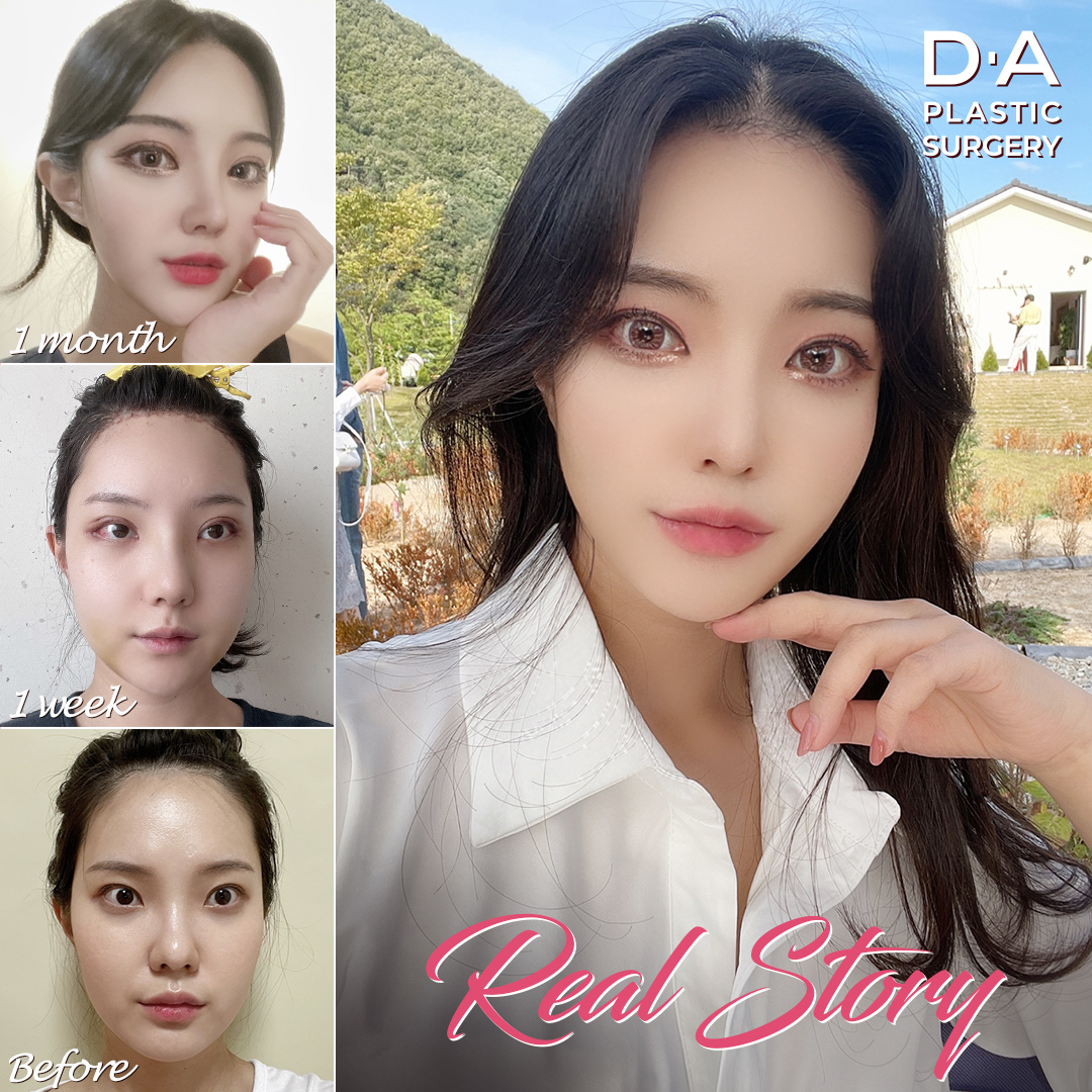 顎先手術 Twitter Search Twitter