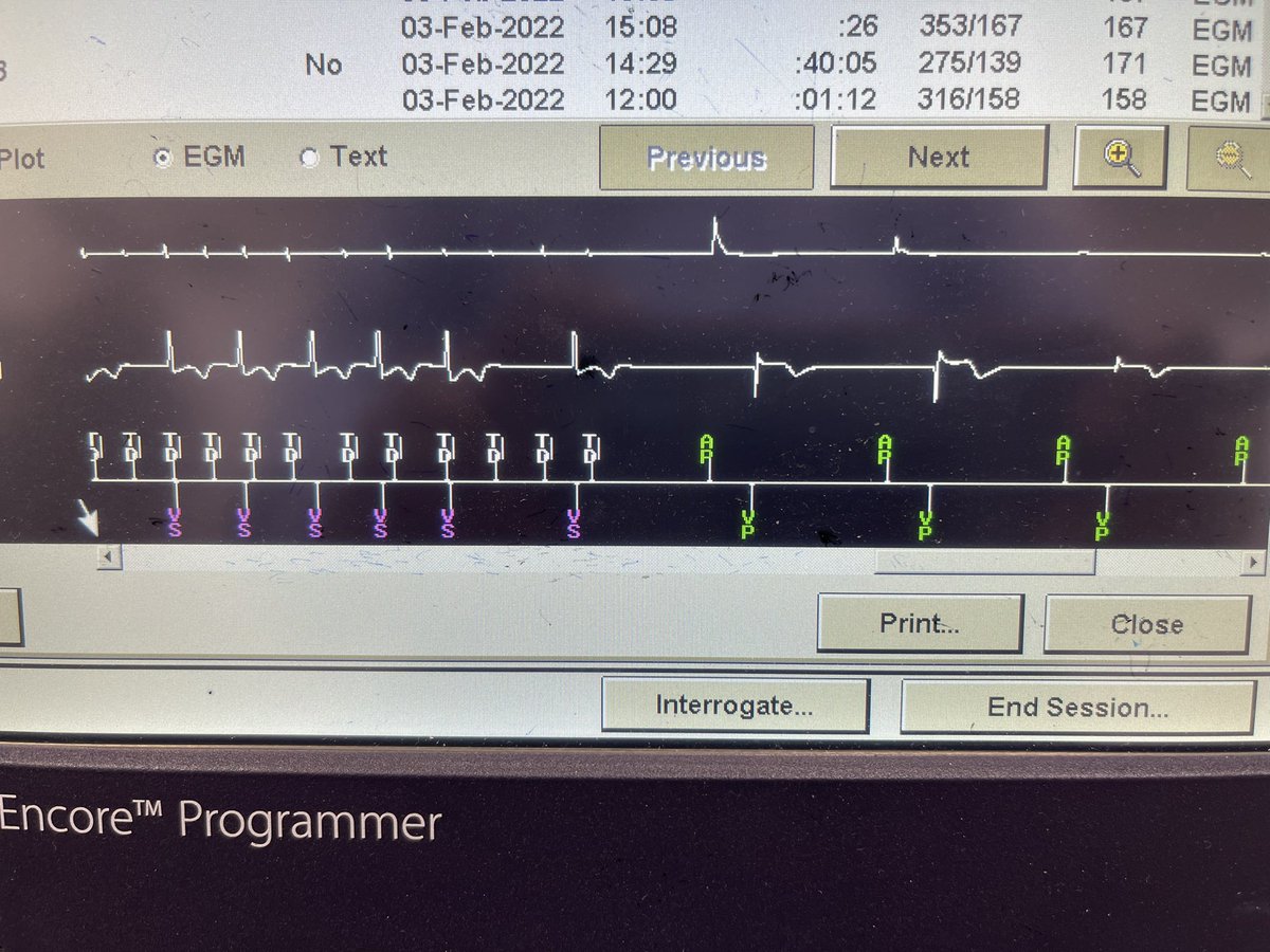 #EPeeps fixing atrial flutter in office by rapid atrial pacing is always fun