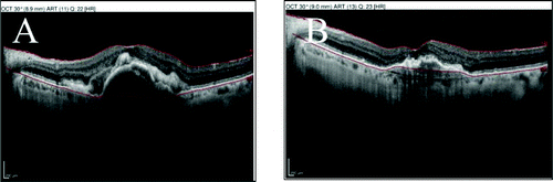 Intravitreal Brolucizumab in Patients with Aflibercept-Resistant Neovascular Age-Related Macular Degeneration
liebertpub.com/doi/10.1089/re…