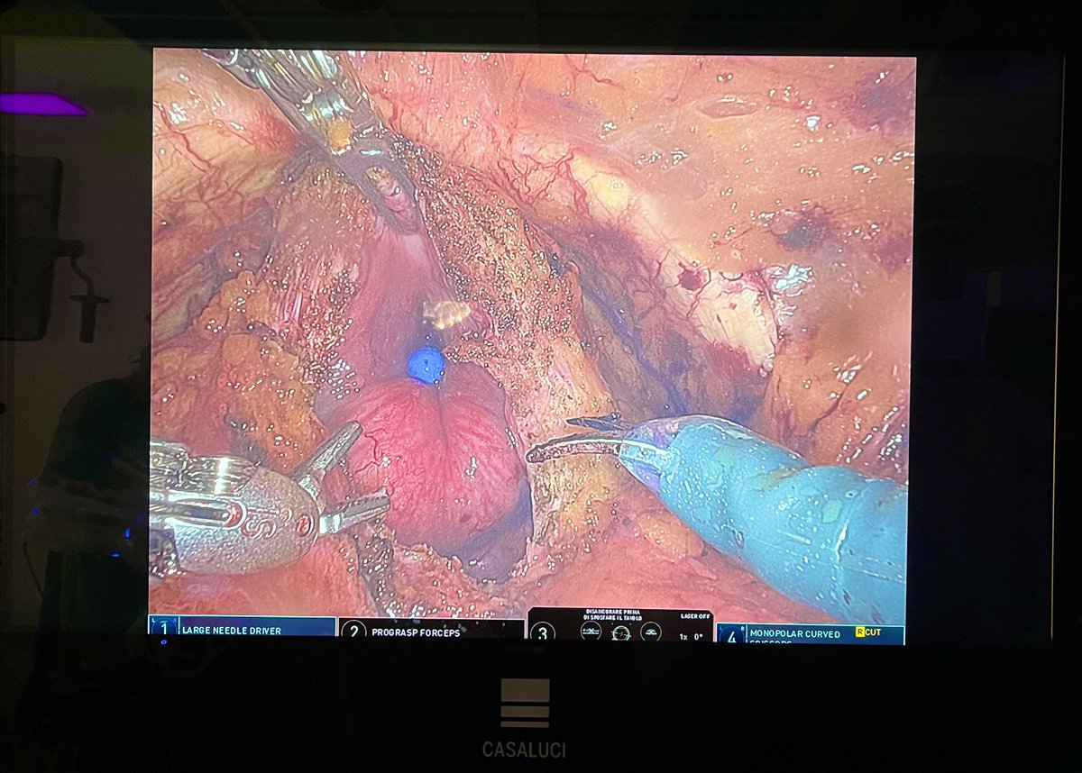 Robotic Adenomectomy ‘Transvesical or transcapsular’? Tell us your opinion #robotics #millin #freyer #bph #santandrea