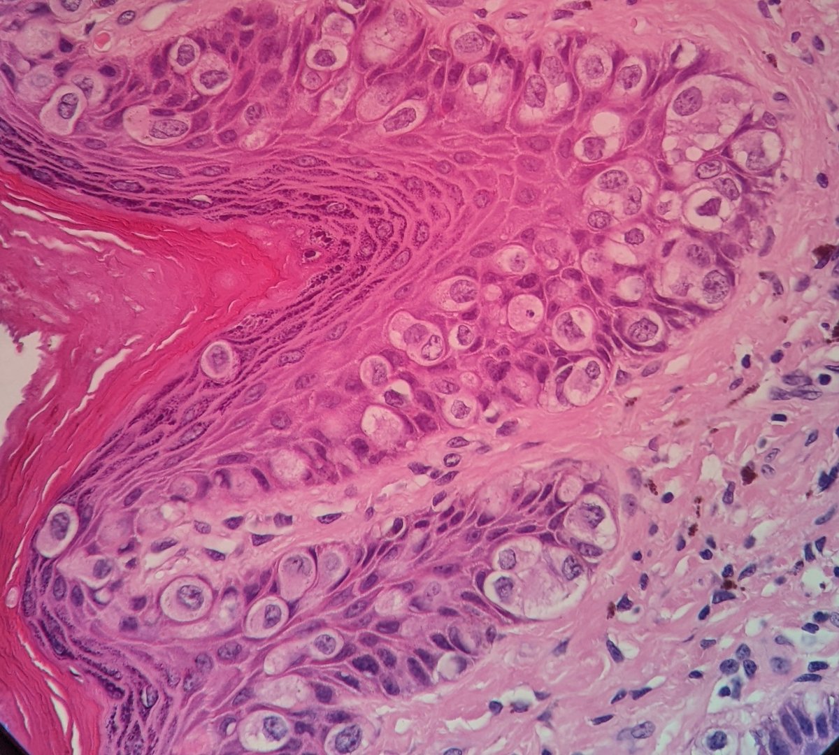 PSzwebel's tweet photo. 85 y/o women
Vulvar Paget Desease with Adenocarcinoma invasive. https://t.co/vC3K4u3j9Q