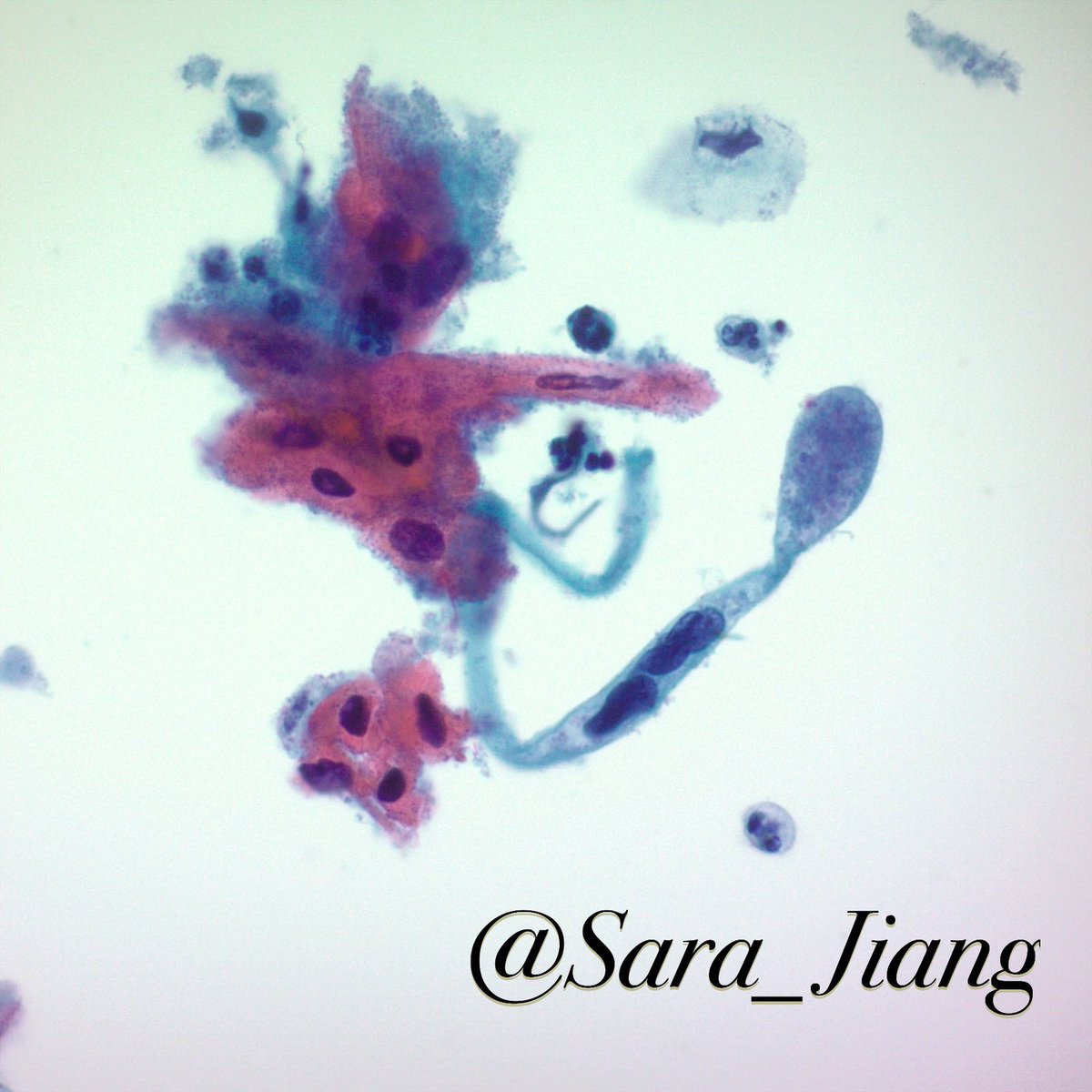 Sara_Jiang's tweet photo. This is an example of squamous cell carcinoma of the cervix:
📍”Tadpole” abnormally shaped cell
📍Atypical keratinizing (pink) cells
📍Necrotic diathesis- granular debris 
Screening and HPV vaccines help prevent these cancers! #NationalCancerPreventionMonth #CytoPath #GYNPath https://t.co/r3M0fLGvSB