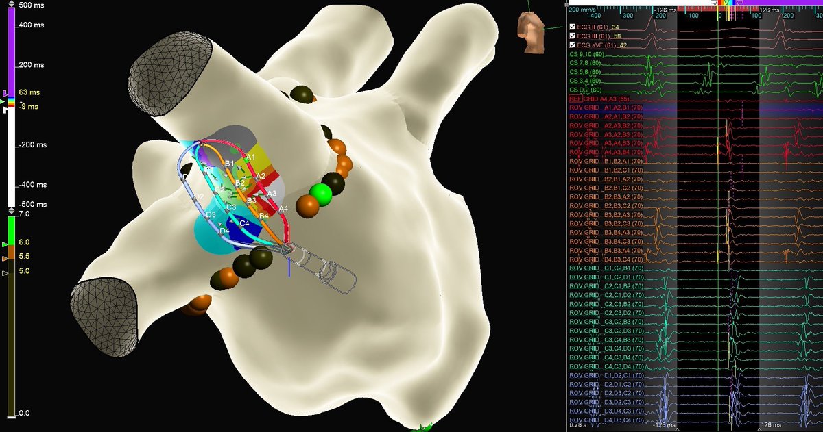 Patient goes into AF when you’re about to finish your line? No problem, #closethegap with OT + Liveview and self reference the #HDGrid! #AbbottProud <a href="/EPeeps_Bot/">EP_Bot</a> <a href="/andresenriqueza/">Andres Enriquez</a> <a href="/ReenaLal3/">Reena Lal</a> <a href="/JasonBaley/">Jason Baley</a>