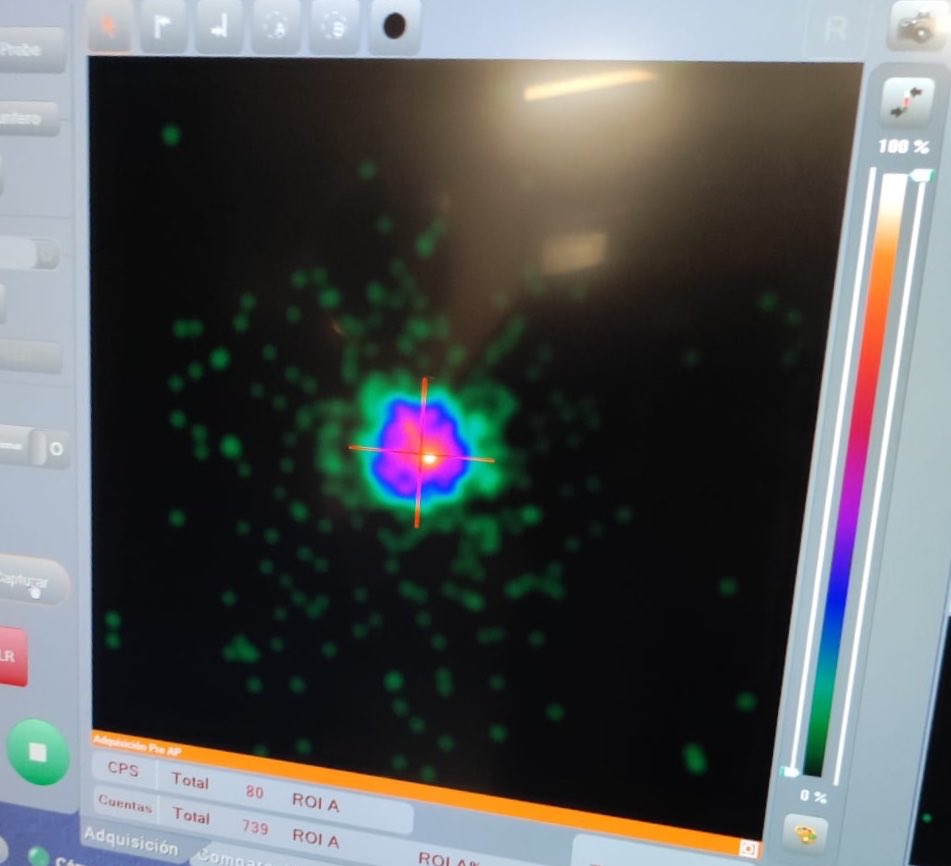 NuclearMadrid's tweet photo. Hoy #4febrero #DiaMundialContraElCancer iniciamos técnica de ROLL (Radioguided Occult Lesion Localization) en nódulo pulmonar con equipo de Cirugía Torácica @RodJcarlosmed @MfOllarves, Dras. Couto, Romero y @MaglenMeneses #SomosClinico https://t.co/rFOzTZHssL