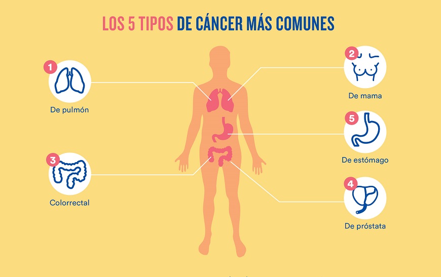 Primeros sintomas de cancer de estomago en mujeres