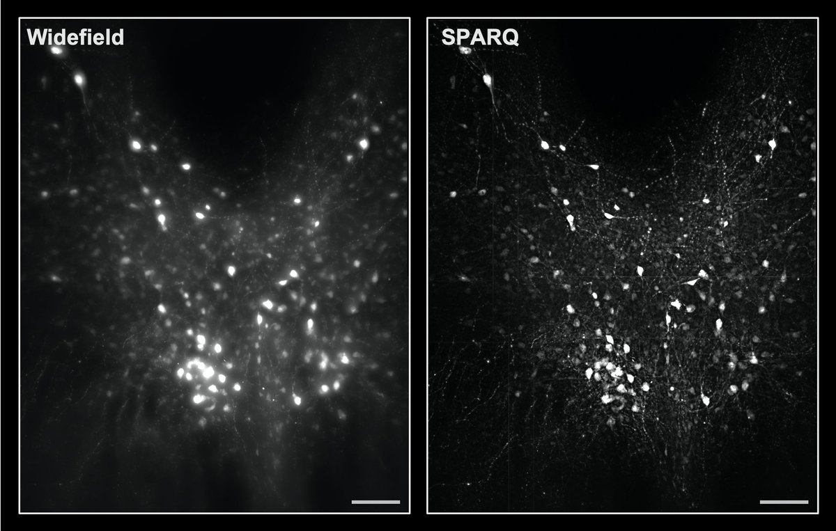 BliqPhotonics's tweet photo. 💡 Application of the SPARQ modality to map serotonergic neurons in the dorsal raphe nucleus region of the mouse brain.

🧠 Widefield (left) versus SPARQ, confocal-like (right).

👉 https://t.co/o5S8H5oRsl

#confocal #opticalsectioning #microscopy #neuroscience https://t.co/Ct2CNsrIsj