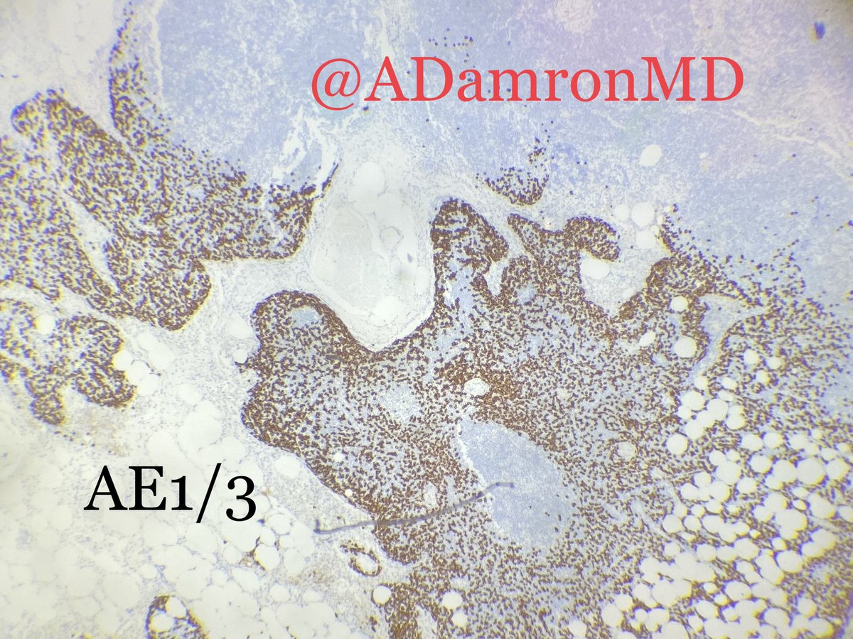 Alexander Damron, MD (@adamronmd) on Twitter photo Don’t ever be hesitant to order keratin stains on sentinel lymph nodes in cases of lobular carcinoma. Sometimes they can look as subtle as sinus histiocytes! #breastpath <a href="/BCM_PathRes/">BCM_PathRes</a> #pathresidents #pathology <a href="/PennPathLabMed/">Penn Path & Lab Medicine</a> <a href="/loyolapathology/">Loyola Pathology & Laboratory Medicine</a> <a href="/QassidO/">Dr Omar Layth Qassid, FRCPath(UK) iFCAP(USA)</a> <a href="/JMGardnerMD/">Jerad Gardner, MD</a> <a href="/jasmeet_assi/">Jasmeet A</a> Don’t ever be hesitant to order keratin stains on sentinel lymph nodes in cases of lobular carcinoma. Sometimes they can look as subtle as sinus histiocytes! #breastpath <a href="/BCM_PathRes/">BCM_PathRes</a> #pathresidents #pathology <a href="/PennPathLabMed/">Penn Path & Lab Medicine</a> <a href="/loyolapathology/">Loyola Pathology & Laboratory Medicine</a> <a href="/QassidO/">Dr Omar Layth Qassid, FRCPath(UK) iFCAP(USA)</a> <a href="/JMGardnerMD/">Jerad Gardner, MD</a> <a href="/jasmeet_assi/">Jasmeet A</a>