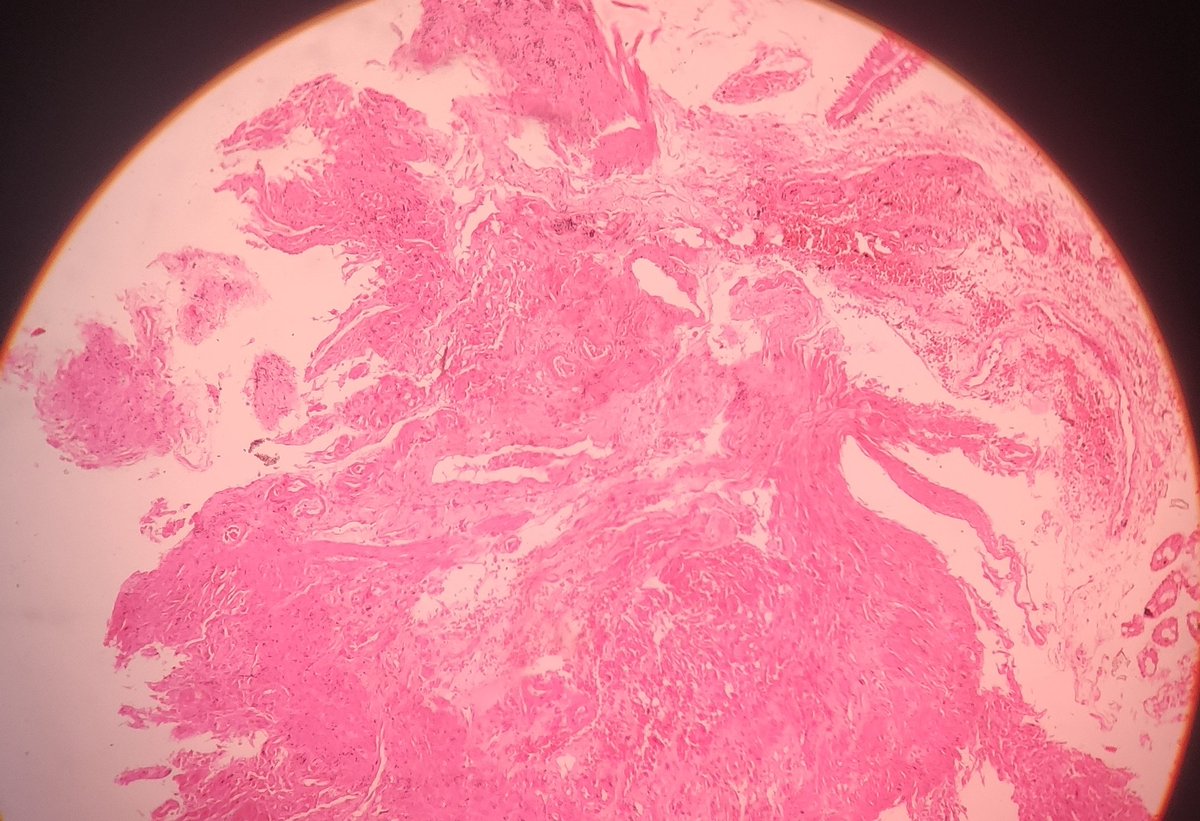 TrishaBanik9's tweet photo. 48y Female, C/O dysphagia, gastric biopsy. #GIpath
D/d https://t.co/3cBSFcnars