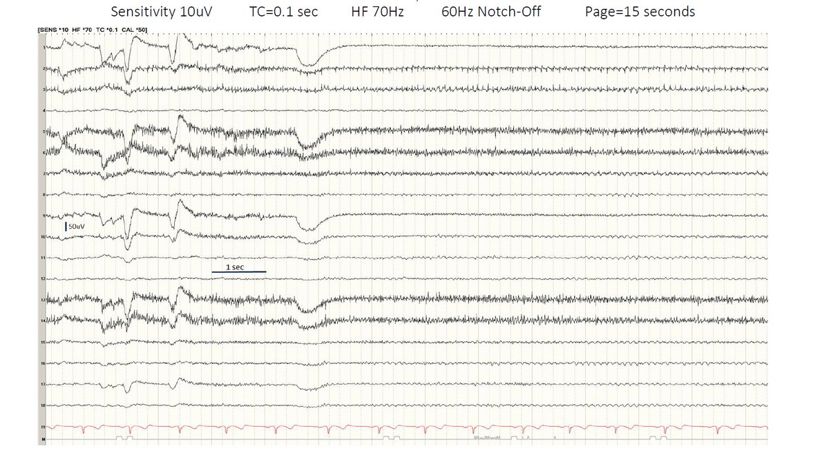 CwruEpilepsy's tweet photo. 📢EEG UNKNOWN QUIZ 2/4/22. Using the key for montages and classification system (Link in our bio), identify the montage, state of consciousness and age of patient for this EEG. Submit your answers here: https://t.co/Gj3tnKzOmW

#EEG #NeuroTwitter 

No answers in comments! https://t.co/NysTVmoAcs