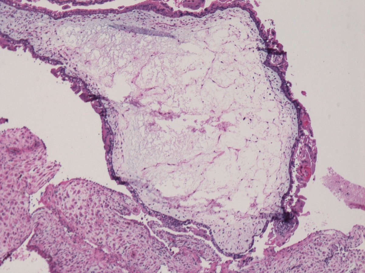 israhkhan's tweet image. 1. cistern formation
2. p57 negative in the villi, but positive in intervillous trophoblast (internal control).
Complete mole is paternally derived and partial has maternal component, so p57 positive #pathtwitter #pathresidents