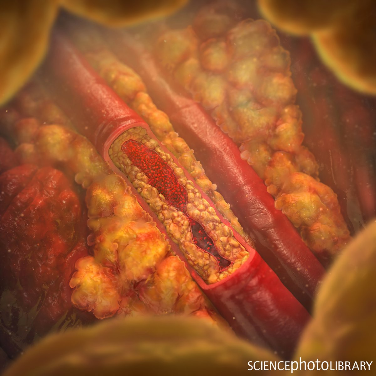 sciencephoto's tweet photo. A cutaway illustration of an artery affected by atherosclerosis, a disease in which the artery is dangerously narrowed by lipid (fat) deposits on the inner walls.
C:Singlecell Animation Llc/SPL
https://t.co/UFeu4oFeqB
#artery #cardiology #medicine #heart #science #sciencephoto https://t.co/SvZLCQn19r