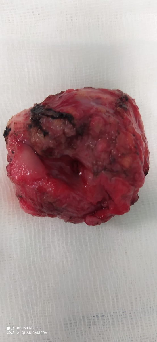 Partial cystectomy for bladder #Paraganglioma. Thanks to all team. (Endocrinology, Anesthesiology and Urology teams) #bladdercancer #partialcystectomy