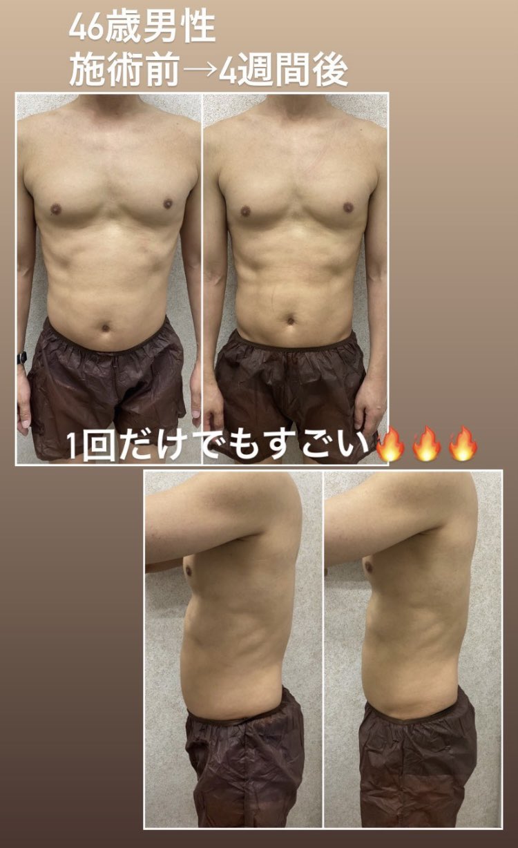 脂肪冷却の吸引カップ　アタッチメント No.1 脂肪冷却 吸引カップ｜Yahoo!フリマ（旧PayPayフリマ）