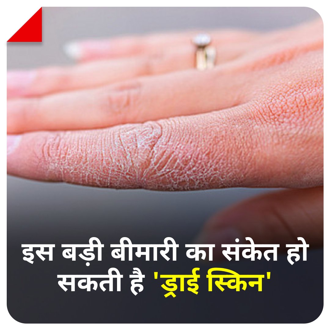 aajtak's tweet photo. डिहाईड्रेशन और सूखी हवा के कारण भी स्किन में ड्राईनेस बनी रहती है. अधिकतर लोग अपनी ड्राई स्किन के लिए मौसम को जिम्मेदार ठहराते हैं. स्किन बार-बार ड्राई होने के पीछे कई गंभीर बीमारियां भी हो सकती हैं जिनमें से एक है किडनी की बीमारी.
#ATCard #DrySkin #Lifestyle #BodyProblem https://t.co/pWCfSZQNx5