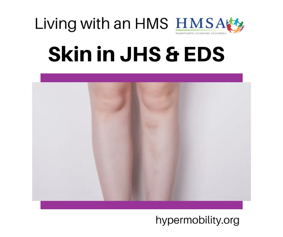 Skin in JHS and EDS

Skin signs are a very important clues as to the possible presence of HMS. There may be skin hyperlaxity, easy bruising, abnormal scarring, and the onset of stretch marks at an early age at multiple sites.

Full article here: bit.ly/3rHrC0Q