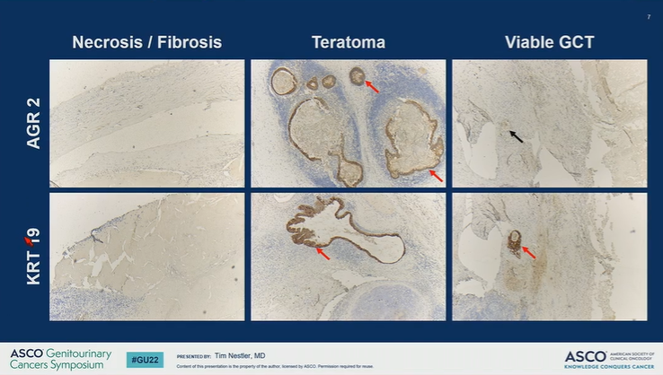 DrChoueiri's tweet photo. Great presentation by Tim Nestler @UniCologne on the value of differentially expressed mRNA and proteins in the diagnosis of GCTs and teratomas vs. necrosis in pcRPLND
@ASCO #GU22

@OncoAlert https://t.co/PGOBx29br6