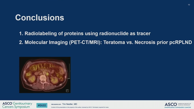 DrChoueiri's tweet photo. Great presentation by Tim Nestler @UniCologne on the value of differentially expressed mRNA and proteins in the diagnosis of GCTs and teratomas vs. necrosis in pcRPLND
@ASCO #GU22

@OncoAlert https://t.co/PGOBx29br6