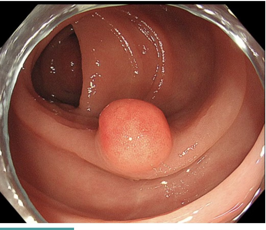 EndoCollab™ | GI Endoscopy Community tweet media