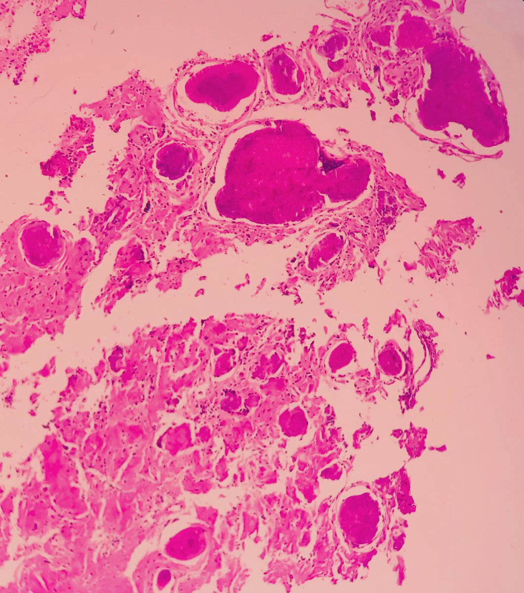 ArezuRhn (@arezurhn) on Twitter photo Amyloid deposition in true vocal cord in a young woman which is presented with dysphonia
#Amyloidosis 
#PathTUMS 
#pathology Amyloid deposition in true vocal cord in a young woman which is presented with dysphonia
#Amyloidosis 
#PathTUMS 
#pathology