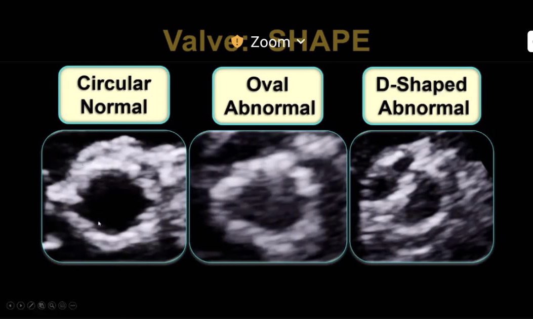 What should a successful TAVR look like? Just ask @renujain19! Beautiful overview at #EchoSOTA of what to look for when assessing TAVR patients  @ASE360 @BijoyKhandheria @abby_kaminski