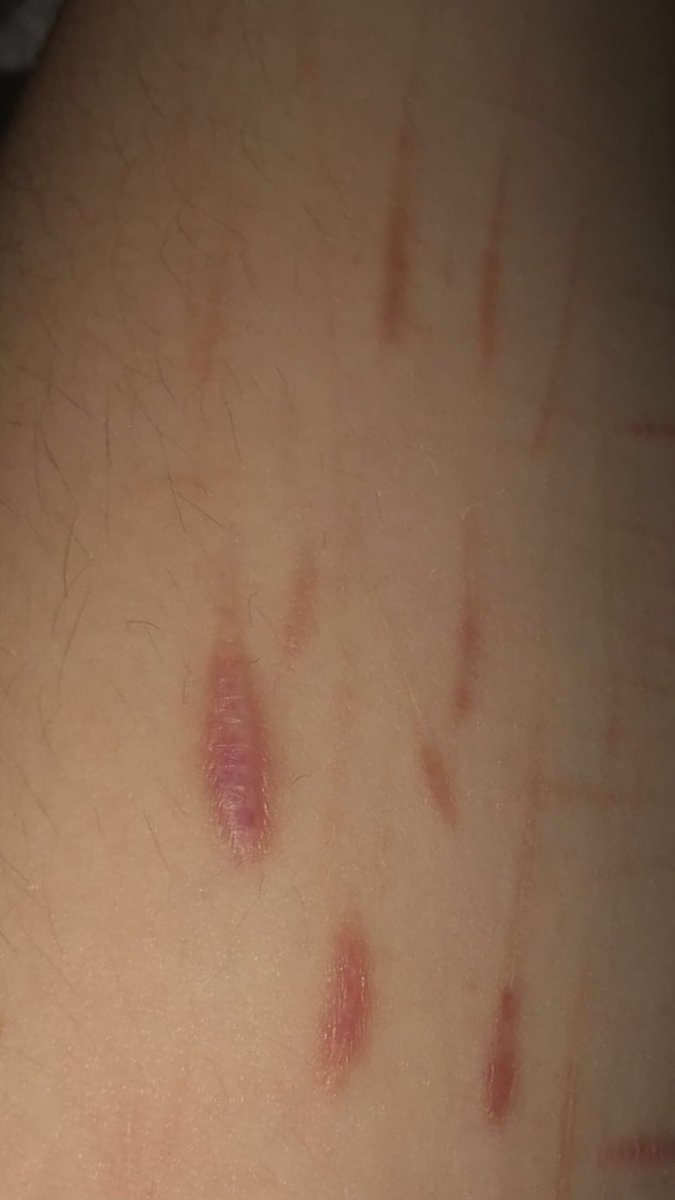wrenfa3's tweet photo. my scars r so bad bruh https://t.co/3T6aLrfIJd
