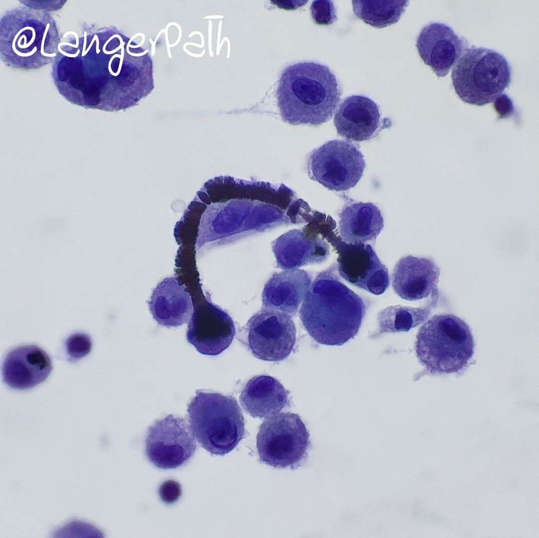 LangerPath's tweet image. Ferruginous bodies in BAL.
Dumbbell-shaped, golden yellow to black with Pap, blue with Perls an golden yellow with H&amp;amp;E.
Happy to have seen them for the first time outside of the books! 😁
#cytopath #cytology