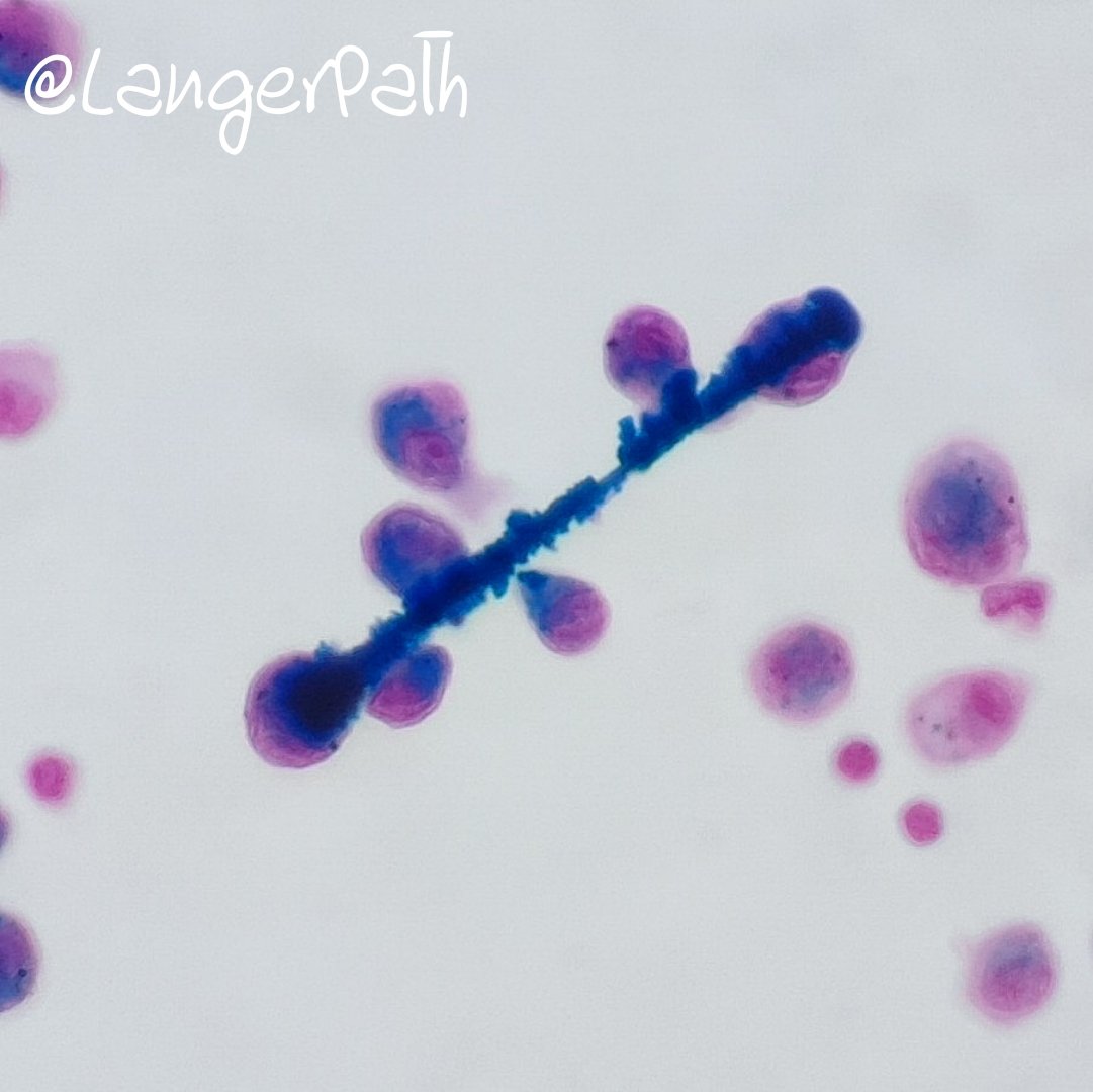 LangerPath's tweet image. Ferruginous bodies in BAL.
Dumbbell-shaped, golden yellow to black with Pap, blue with Perls an golden yellow with H&amp;amp;E.
Happy to have seen them for the first time outside of the books! 😁
#cytopath #cytology