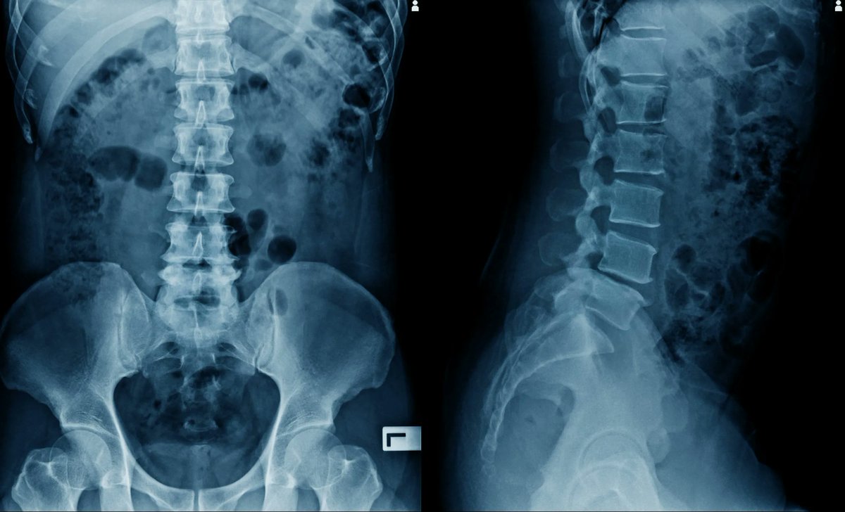 we_are_upstart's tweet photo. Man With Severed Spinal Cord Walks Again, Thanks to AI Implant https://t.co/VqAa29xRoy https://t.co/VoO8IeFT1K
