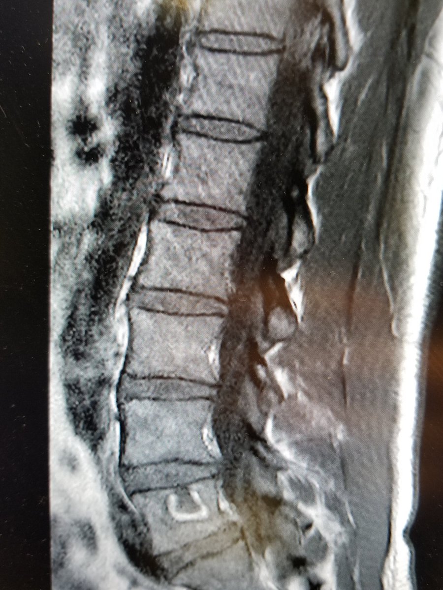 KayLisandro's tweet photo. @drfischerspine Hi Dr Fischer, I sustained an injury back in September doing squats. I was told I have osteophytes and disc herniation. Am I suffering from degenerative disc disease ? Is there any way based on these MRIs that I could do sports activities I enjoy again ? Thank you https://t.co/EZasgyqFHq