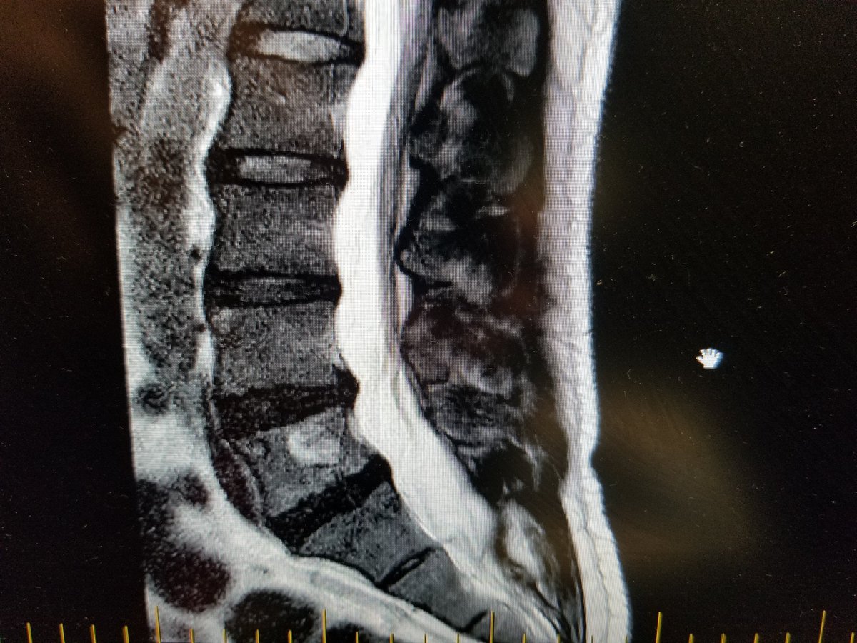 KayLisandro's tweet photo. @drfischerspine Hi Dr Fischer, I sustained an injury back in September doing squats. I was told I have osteophytes and disc herniation. Am I suffering from degenerative disc disease ? Is there any way based on these MRIs that I could do sports activities I enjoy again ? Thank you https://t.co/EZasgyqFHq