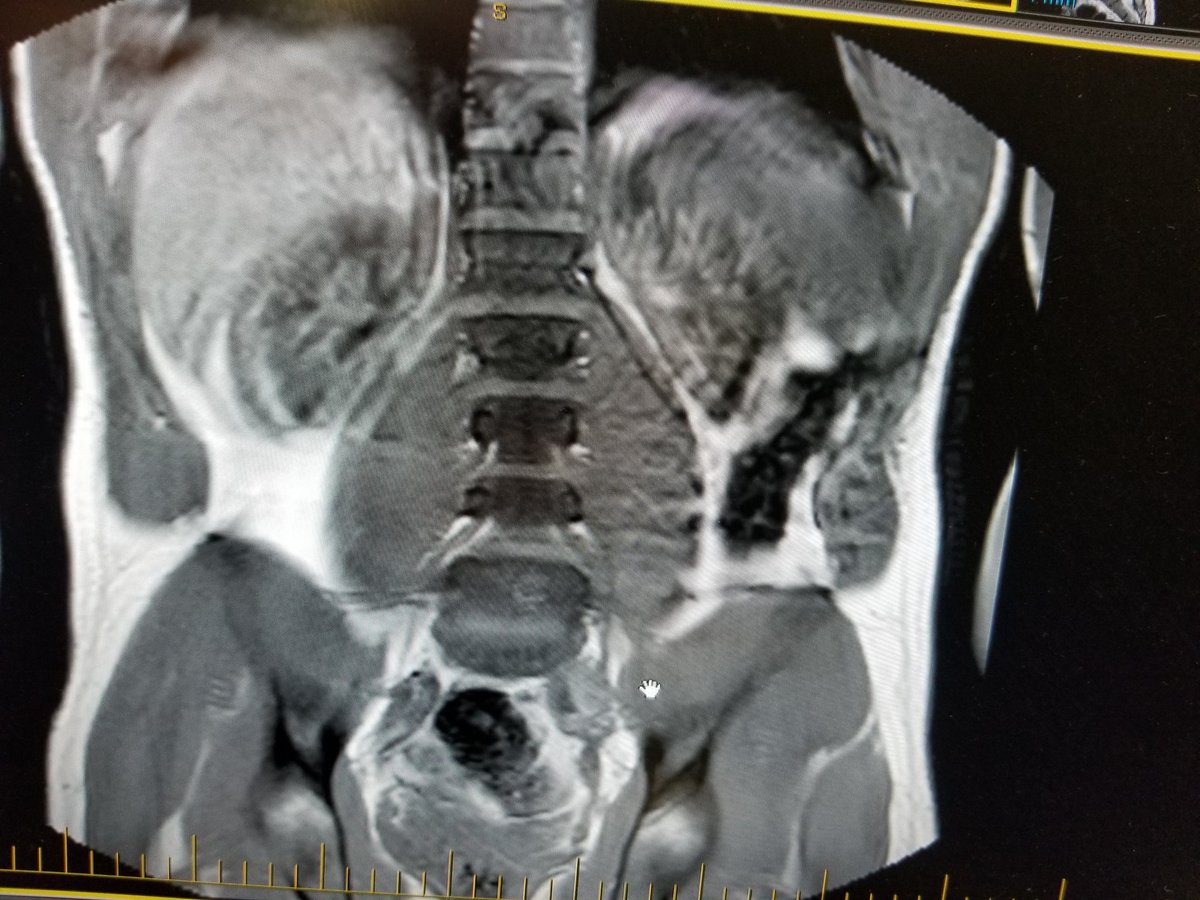KayLisandro's tweet photo. @drfischerspine Hi Dr Fischer, I sustained an injury back in September doing squats. I was told I have osteophytes and disc herniation. Am I suffering from degenerative disc disease ? Is there any way based on these MRIs that I could do sports activities I enjoy again ? Thank you https://t.co/EZasgyqFHq