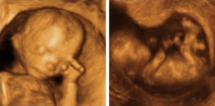 VIVErevista's tweet photo. Esta es la imagen de un bebe de 12 semanas. La Asamblea acaba de aprobar ese plazo y de manera excepcional 18 semanas. #LeyAbortistaNo https://t.co/59LKcpygWa